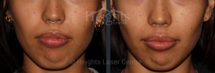 Before & After Lip Filler—Love Your Lips™ Case 44 Front View in Vancouver (Burnaby), BC