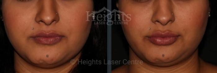 Before & After Lip Filler—Love Your Lips™ Case 46 Front View in Vancouver (Burnaby), BC