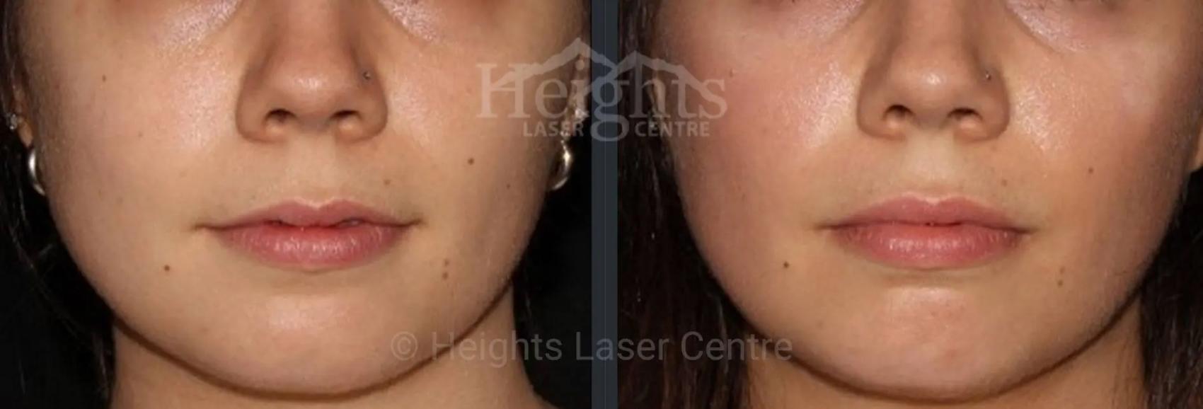 Before & After Lip Filler—Love Your Lips™ Case 48 Front View in Vancouver (Burnaby), BC