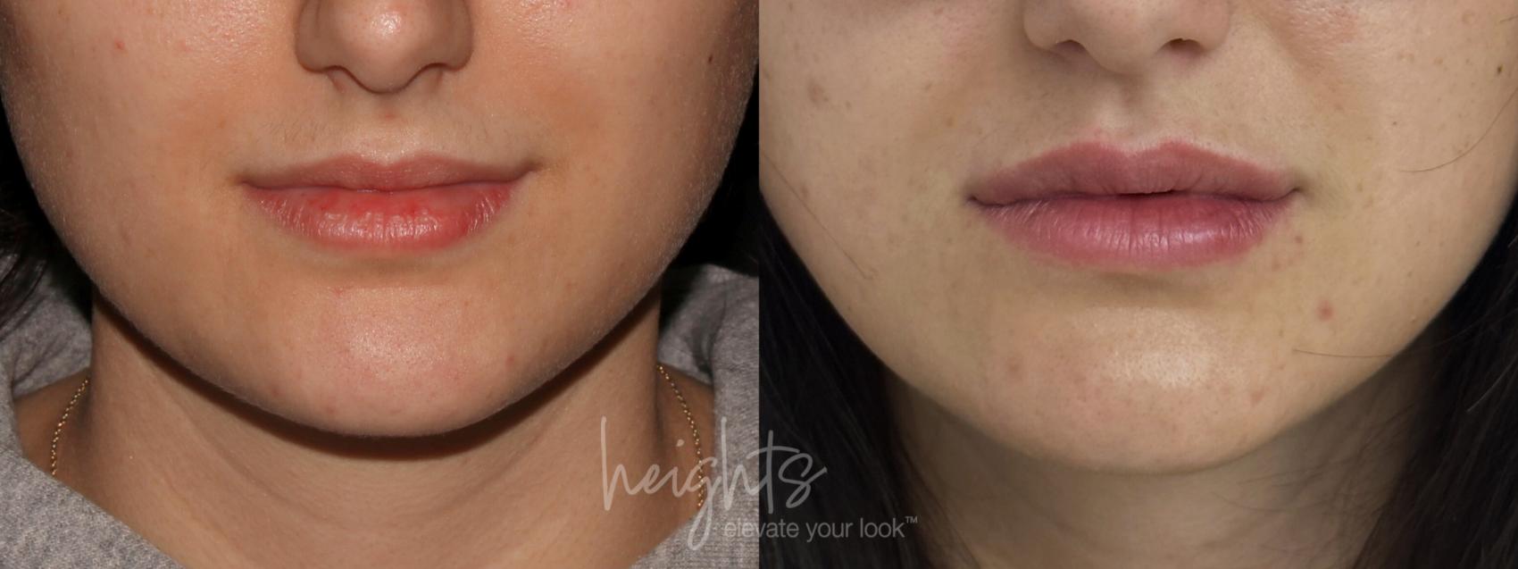 Before & After Lip Filler—Love Your Lips™ Case 89 Front View in Vancouver (Burnaby), BC