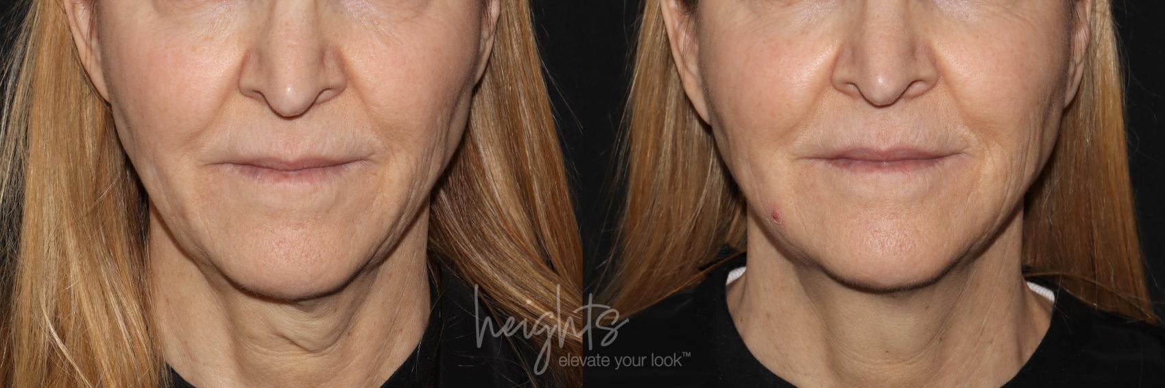 Before & After Liquid Facelift Case 106 Front View in Vancouver (Burnaby), BC
