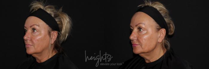 Before & After Liquid Facelift Case 113 Left Oblique View in Vancouver (Burnaby), BC