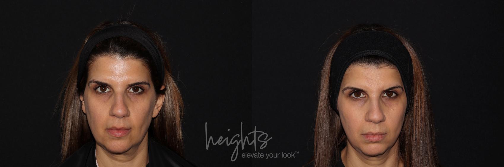 Before & After Liquid Facelift Case 130 Front View in Vancouver (Burnaby), BC