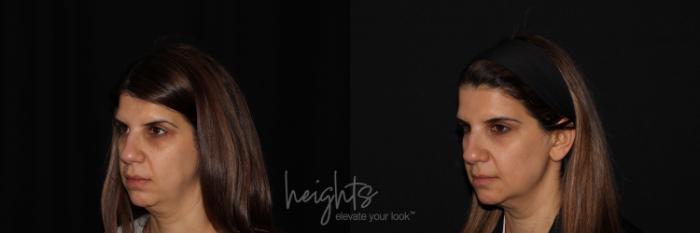 Before & After BOTOX COSMETIC® Case 130 Left Oblique View in Vancouver (Burnaby), BC