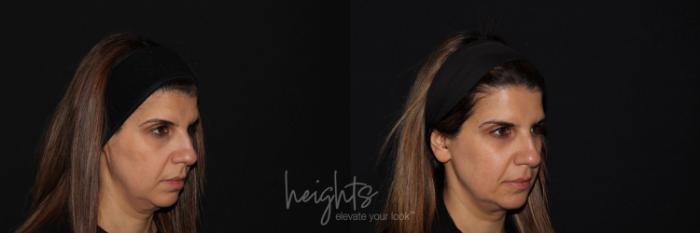 Before & After BOTOX COSMETIC® Case 130 Right Oblique View in Vancouver (Burnaby), BC