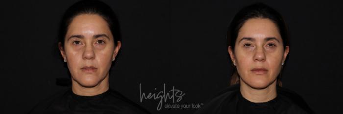 Before & After Liquid Facelift Case 131 Front View in Vancouver (Burnaby), BC