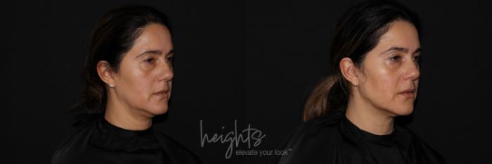 Before & After Liquid Facelift Case 131 Right Oblique View in Vancouver (Burnaby), BC