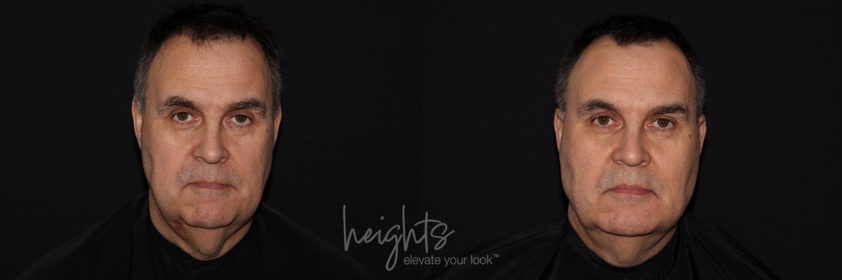 Before & After Liquid Facelift Case 134 Front View in Vancouver (Burnaby), BC