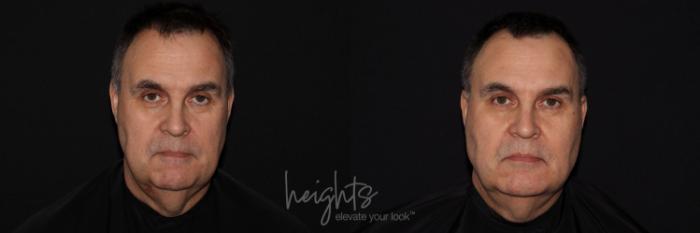 Before & After Liquid Facelift Case 134 Front View in Vancouver (Burnaby), BC