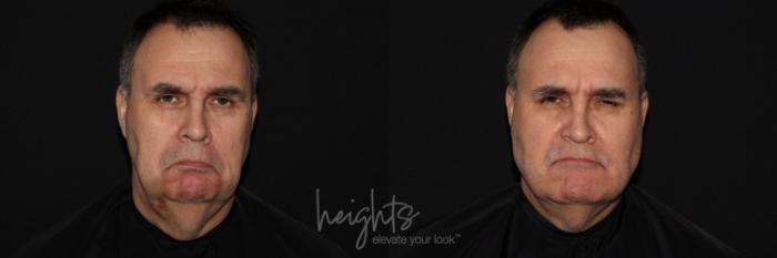 Before & After Liquid Facelift Case 134 Frontal frown View in Vancouver (Burnaby), BC