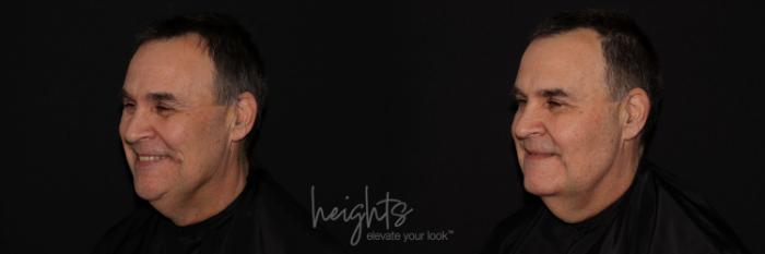 Before & After Liquid Facelift Case 134 left oblique crows feet View in Vancouver (Burnaby), BC
