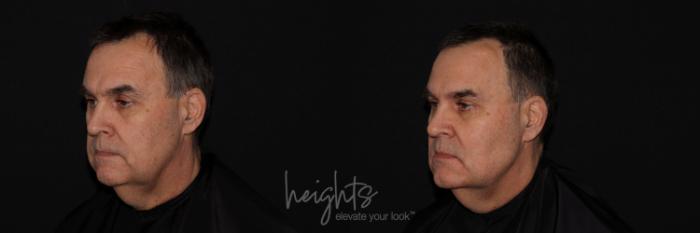 Before & After Liquid Facelift Case 134 Left Oblique View in Vancouver (Burnaby), BC