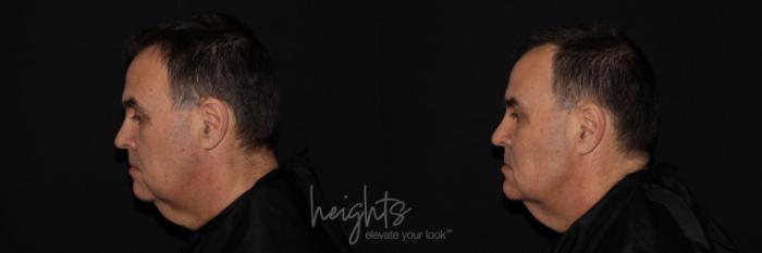 Before & After Liquid Facelift Case 134 Left Side View in Vancouver (Burnaby), BC