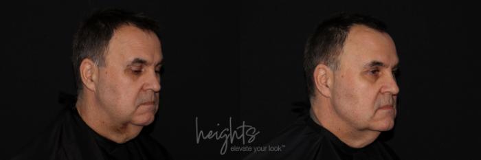Before & After Liquid Facelift Case 134 Right Oblique View in Vancouver (Burnaby), BC