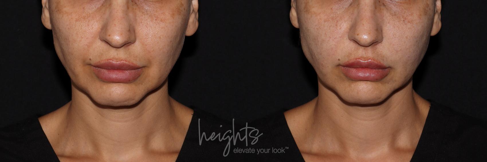Before & After Liquid Facelift Case 143 Front View in Vancouver (Burnaby), BC