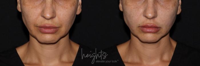 Before & After Liquid Facelift Case 143 Front View in Vancouver (Burnaby), BC