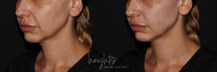 Before & After Liquid Facelift Case 143 Left Oblique View in Vancouver (Burnaby), BC