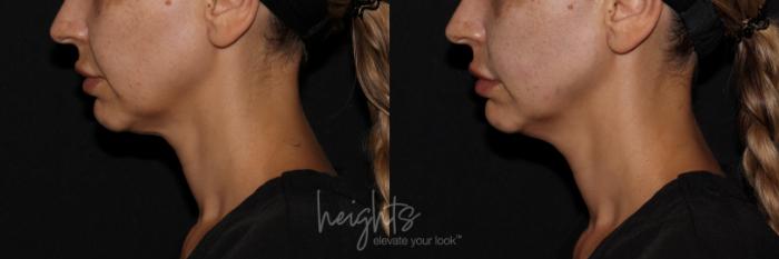 Before & After Liquid Facelift Case 143 Left Side View in Vancouver (Burnaby), BC