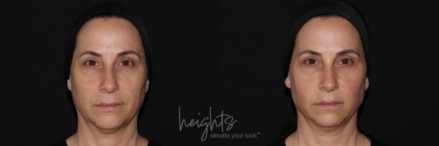 Before & After Liquid Facelift Case 144 Front View in Vancouver (Burnaby), BC