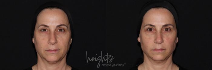 Before & After Liquid Facelift Case 144 Front View in Vancouver (Burnaby), BC