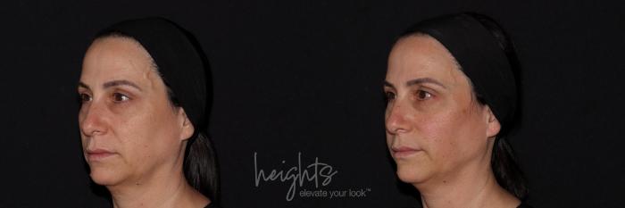 Before & After Liquid Facelift Case 144 Left Oblique View in Vancouver (Burnaby), BC