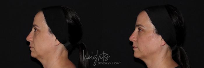 Before & After Liquid Facelift Case 144 Left Side View in Vancouver (Burnaby), BC