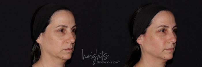 Before & After Liquid Facelift Case 144 Right Oblique View in Vancouver (Burnaby), BC