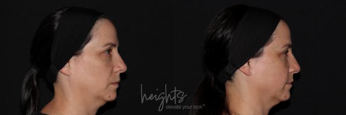 Before & After Liquid Facelift Case 144 Right Side View in Vancouver (Burnaby), BC