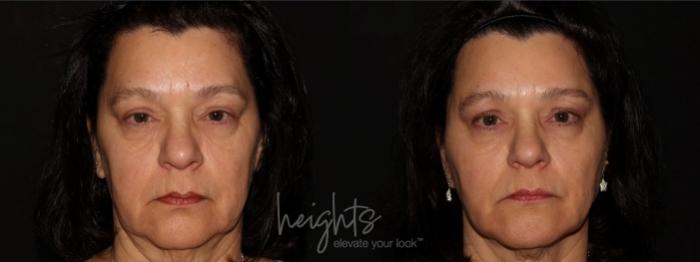 Before & After BOTOX COSMETIC® Case 84 Front View in Vancouver (Burnaby), BC